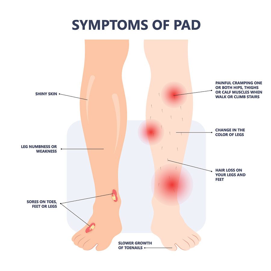 PAD Symptoms, Fairfax Vascular Center