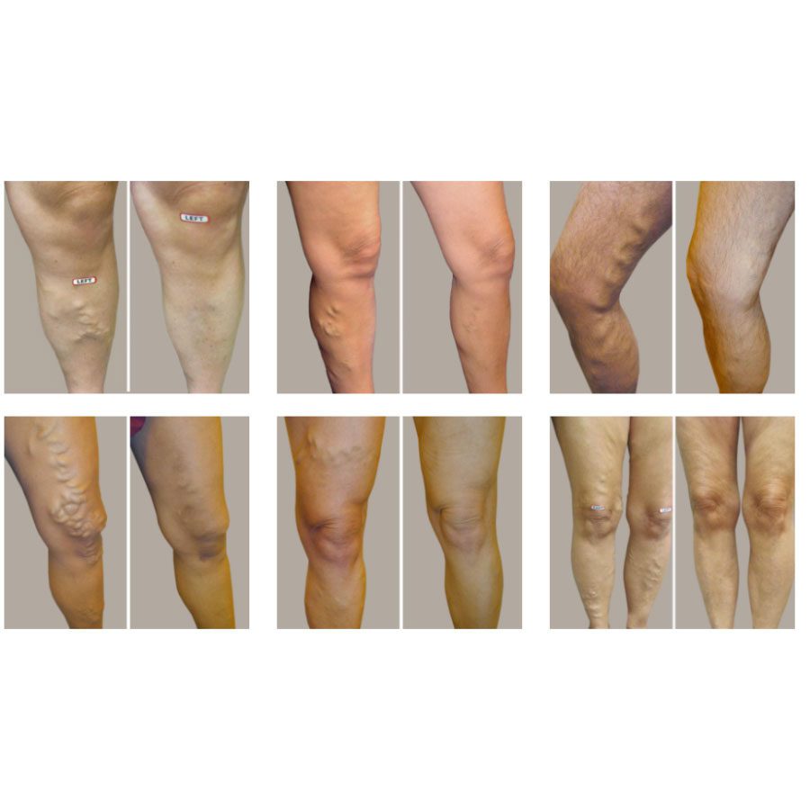varicose veins, before and after treatment