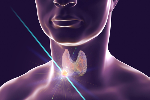 What is thyroid nodule radiofrequency ablation?