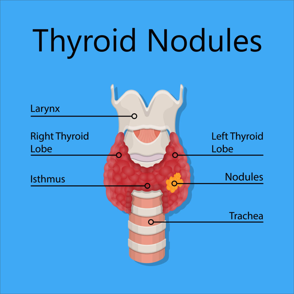 Thyroid Nodule Radiofrequency Ablation Fvc