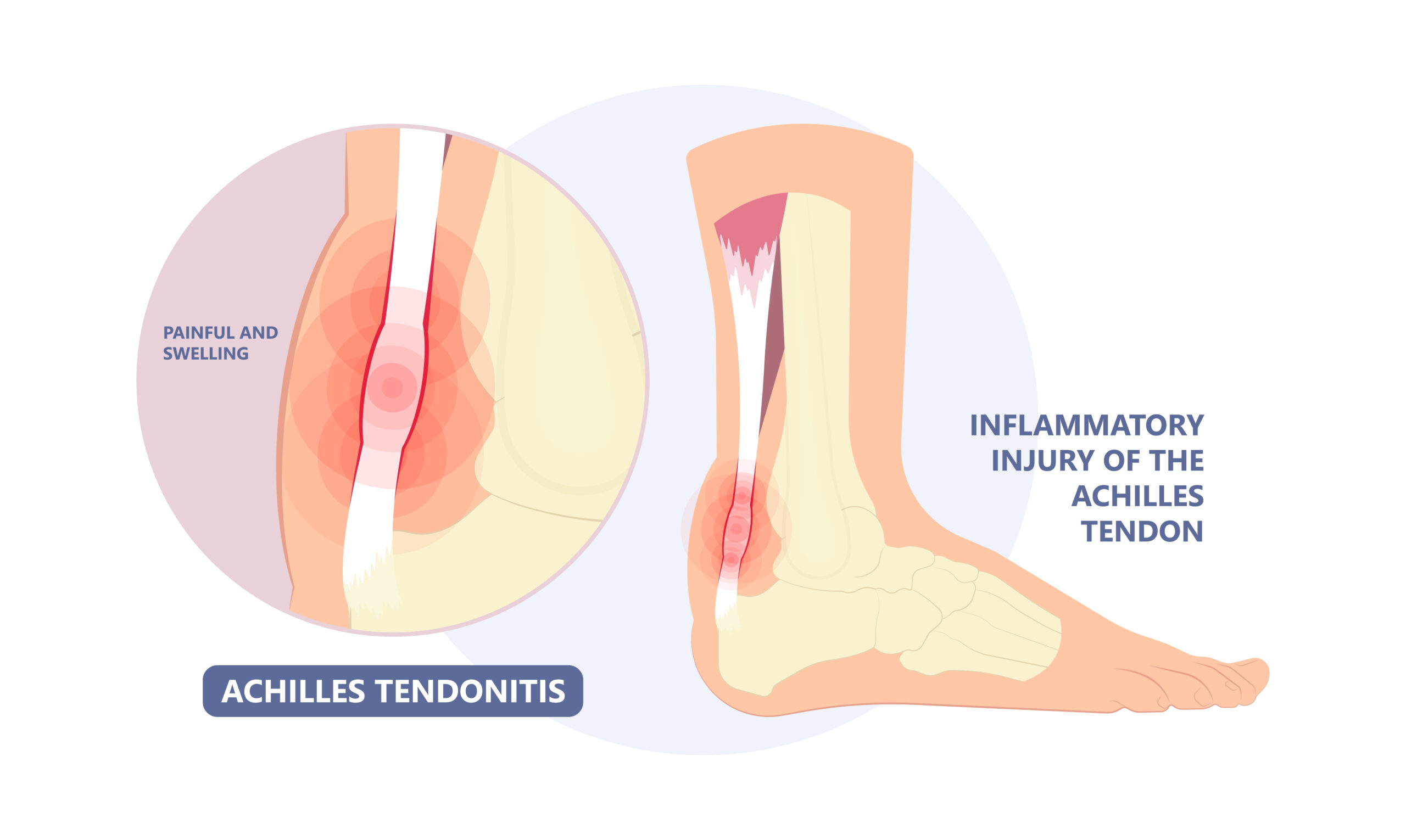 Achilles Tendonitis Treatment in Fairfax - Achilles Tendon Pain Relief