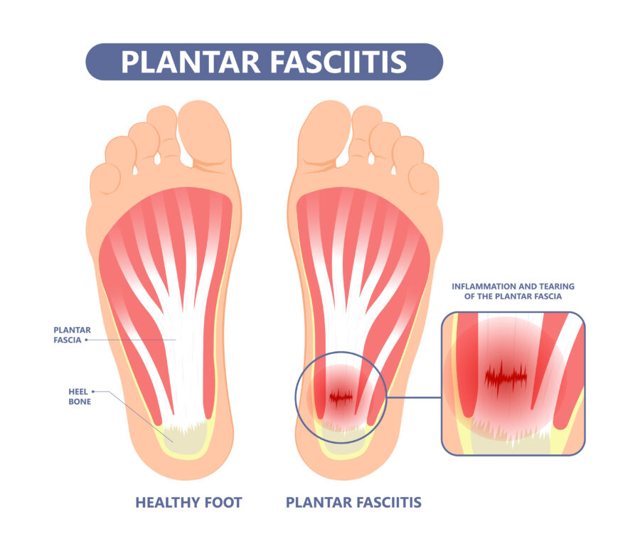Plantar Fasciitis Treatment in Fairfax