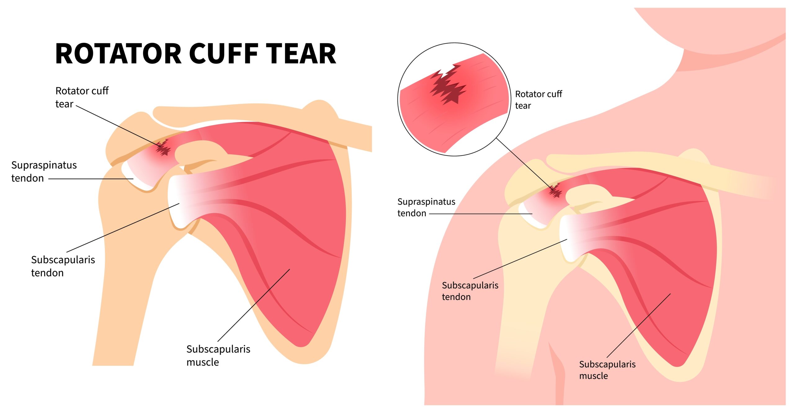 Rotator Cuff Tear Treatment in Fairfax – Rotator Cuff Injury Repair